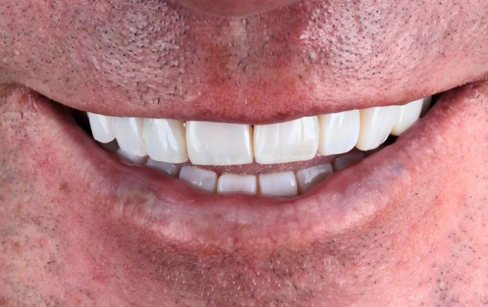 After - Walmsley Dental