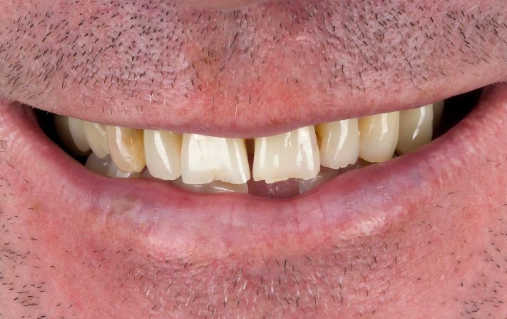 Before - Walmsley Dental