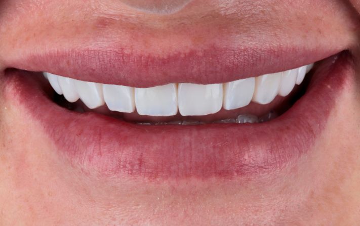 After - Walmsley Dental