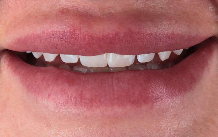 Before - Walmsley Dental