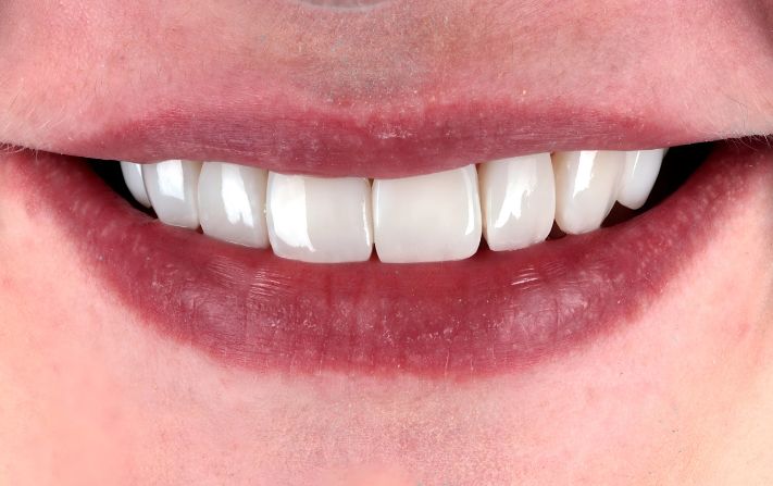 After - Walmsley Dental