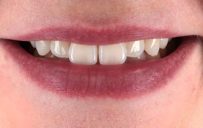 Before - Walmsley Dental