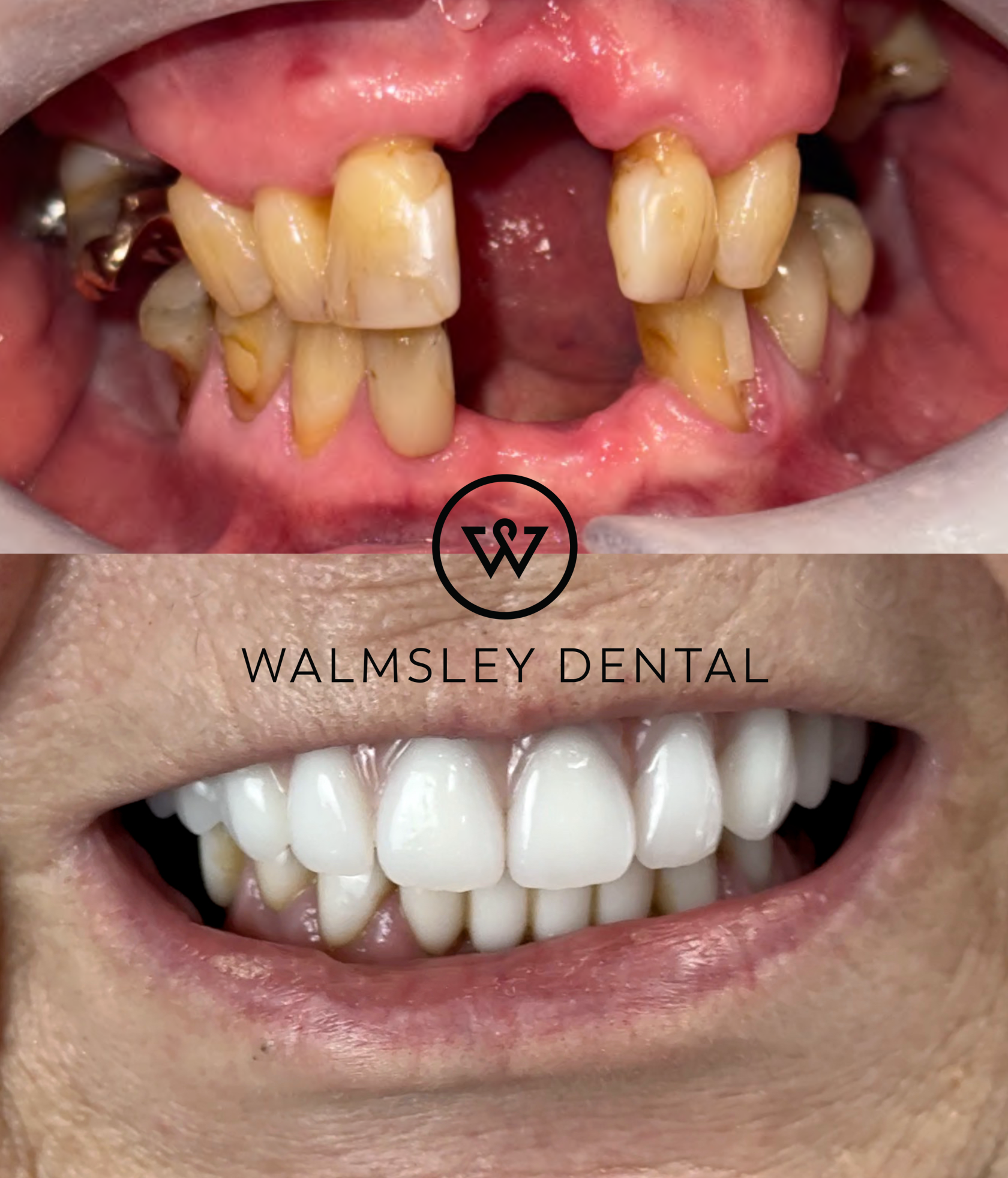 All-on-4 full-arch dental implants before and after — Walmsley Dental Droylsden