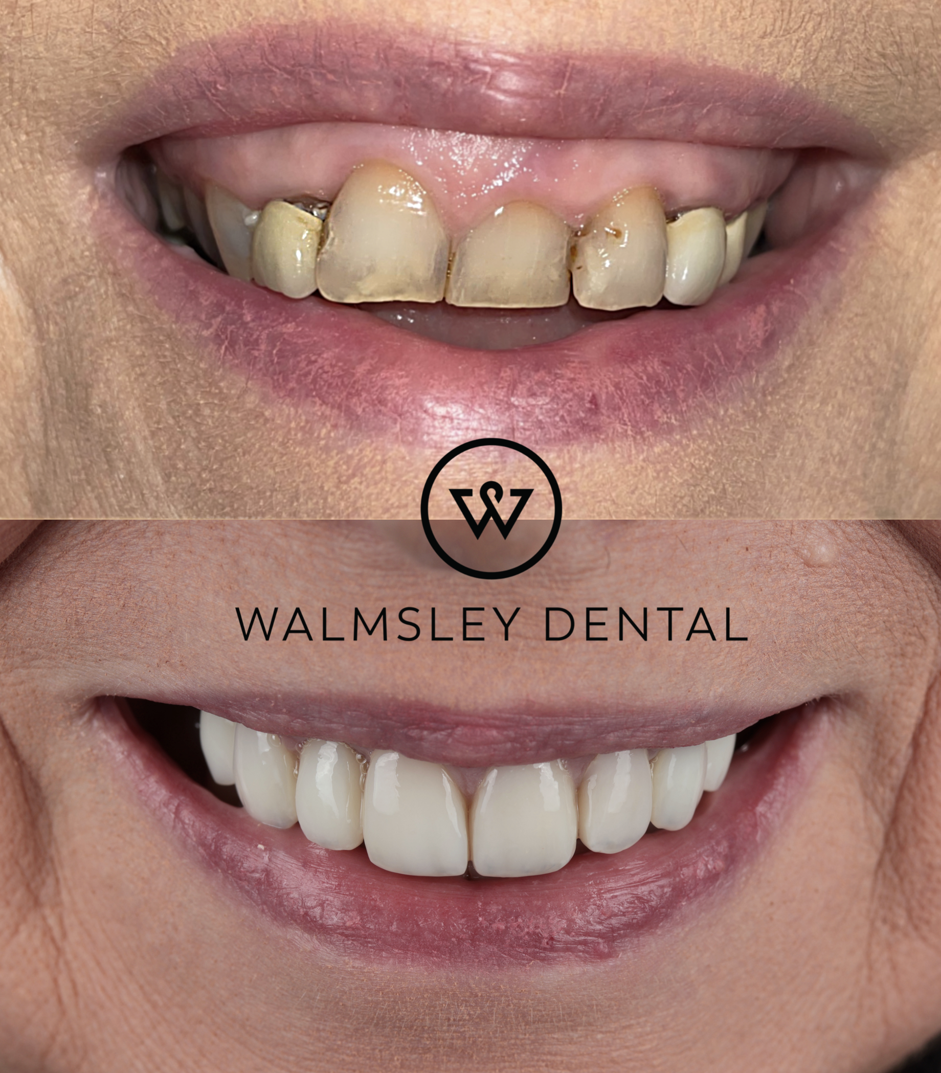 Bespoke smile design before and after — Walmsley Dental Droylsden