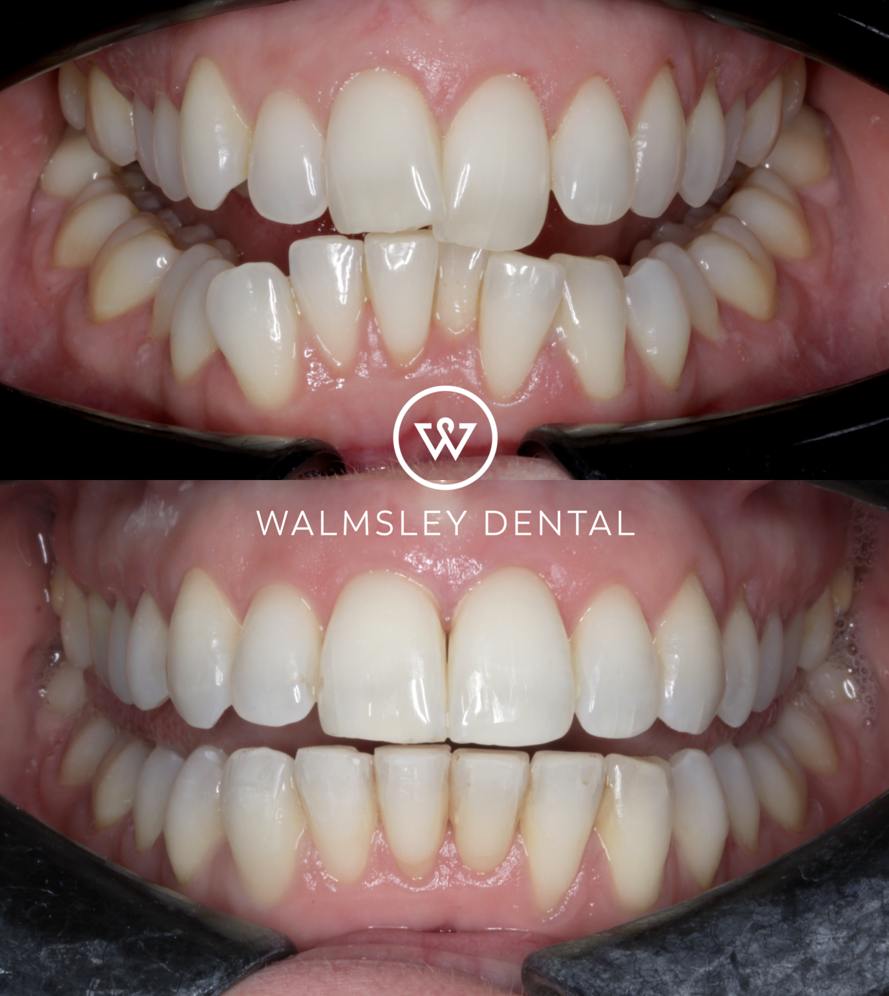 Walmsley Dental ceramic braces before and after