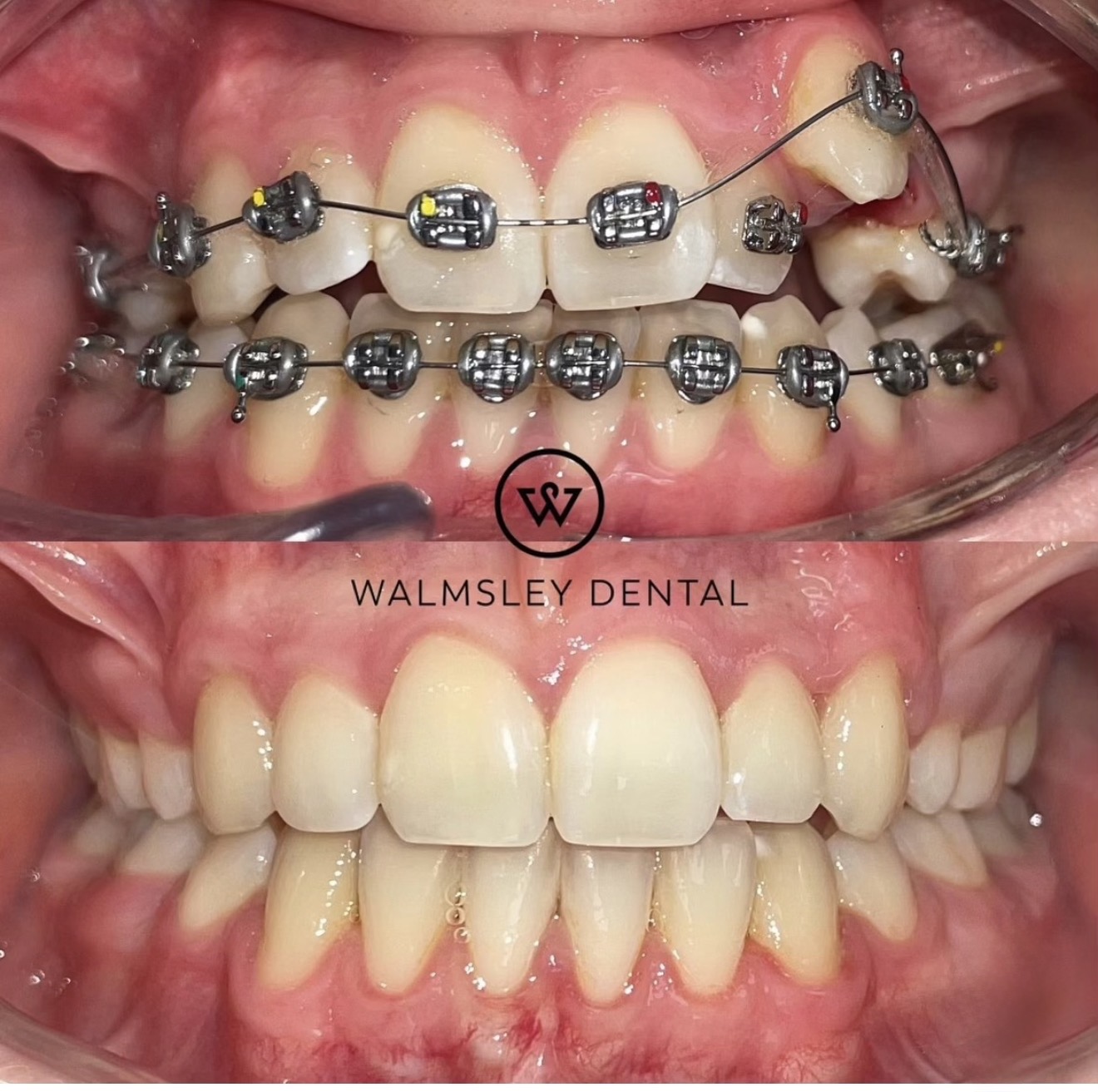 Walmsley Dental children's braces before and after