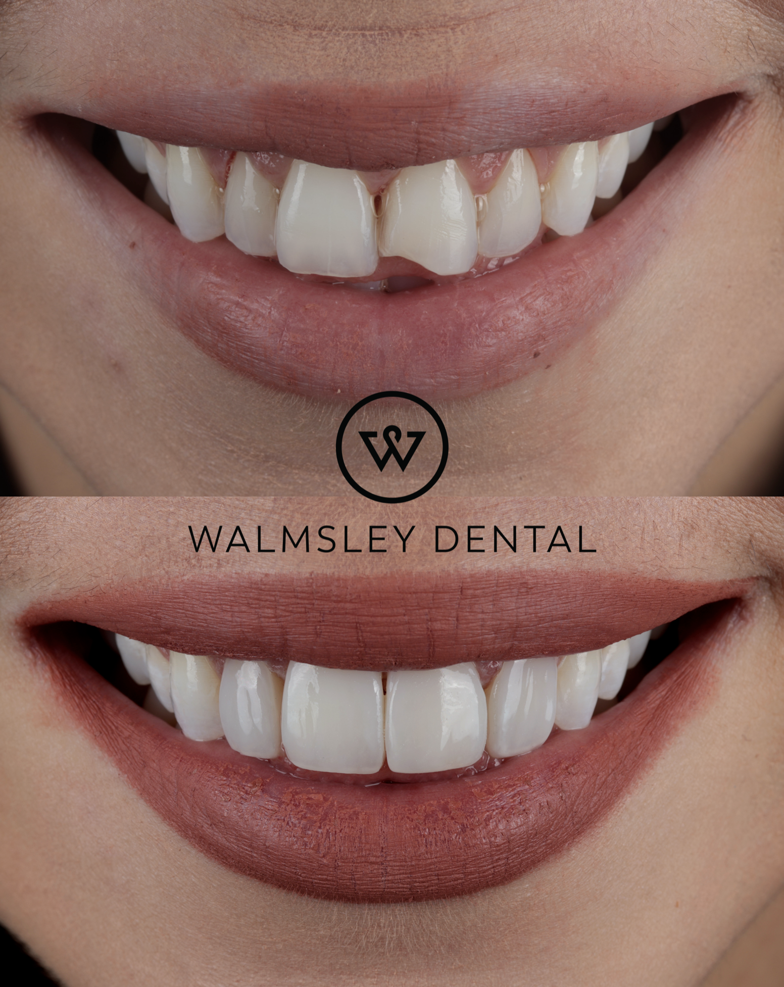 Composite bonding before and after — Walmsley Dental Droylsden