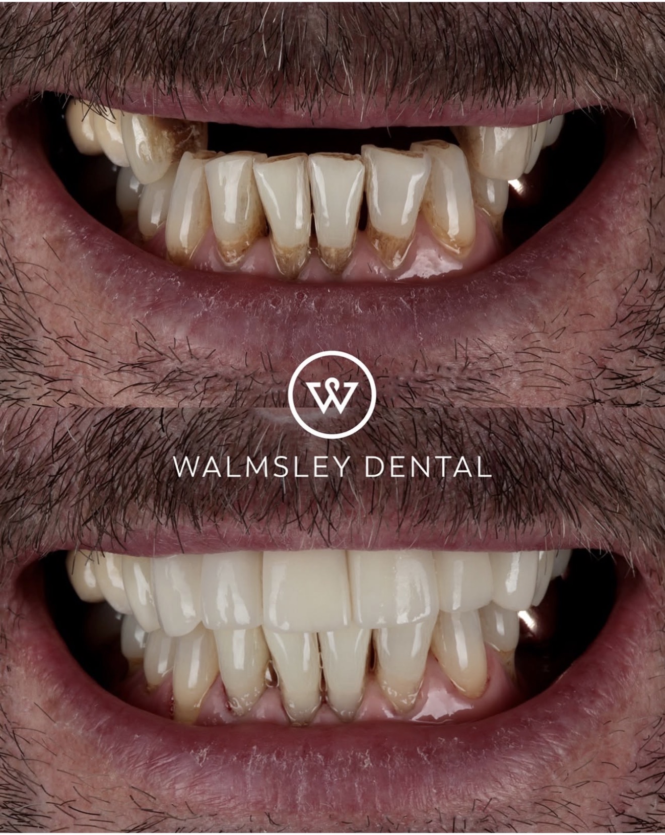 Implant-retained front teeth bridge — Walmsley Dental Droylsden