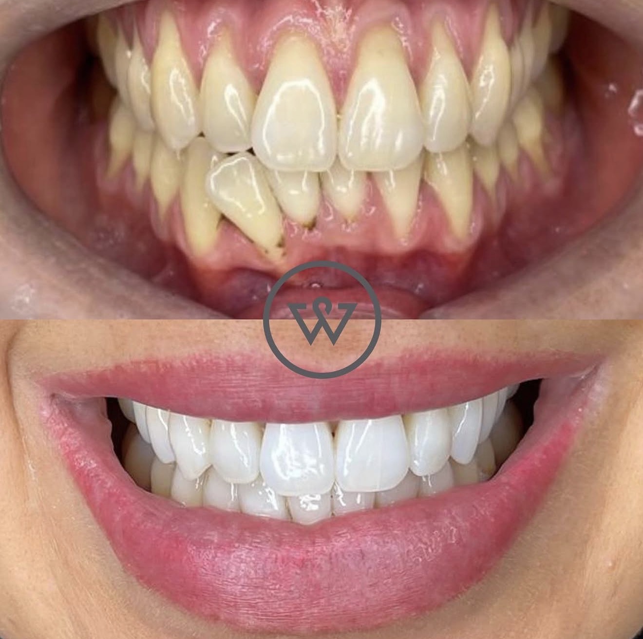 Walmsley Dental clear aligner before and after