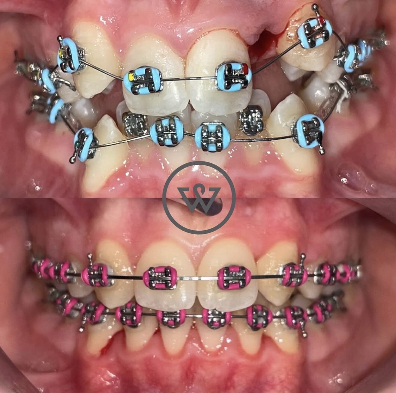 Walmsley Dental child metal braces before and after