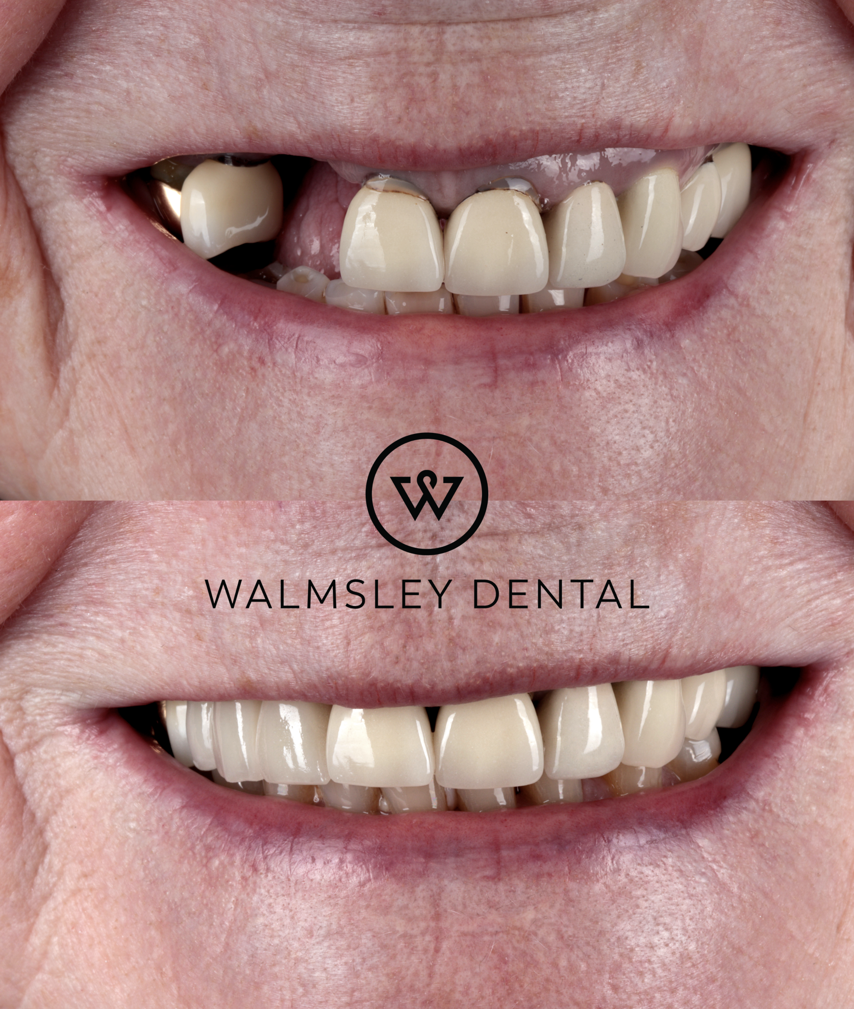 Replacing missing front teeth with implants — before and after, Walmsley Dental Droylsden