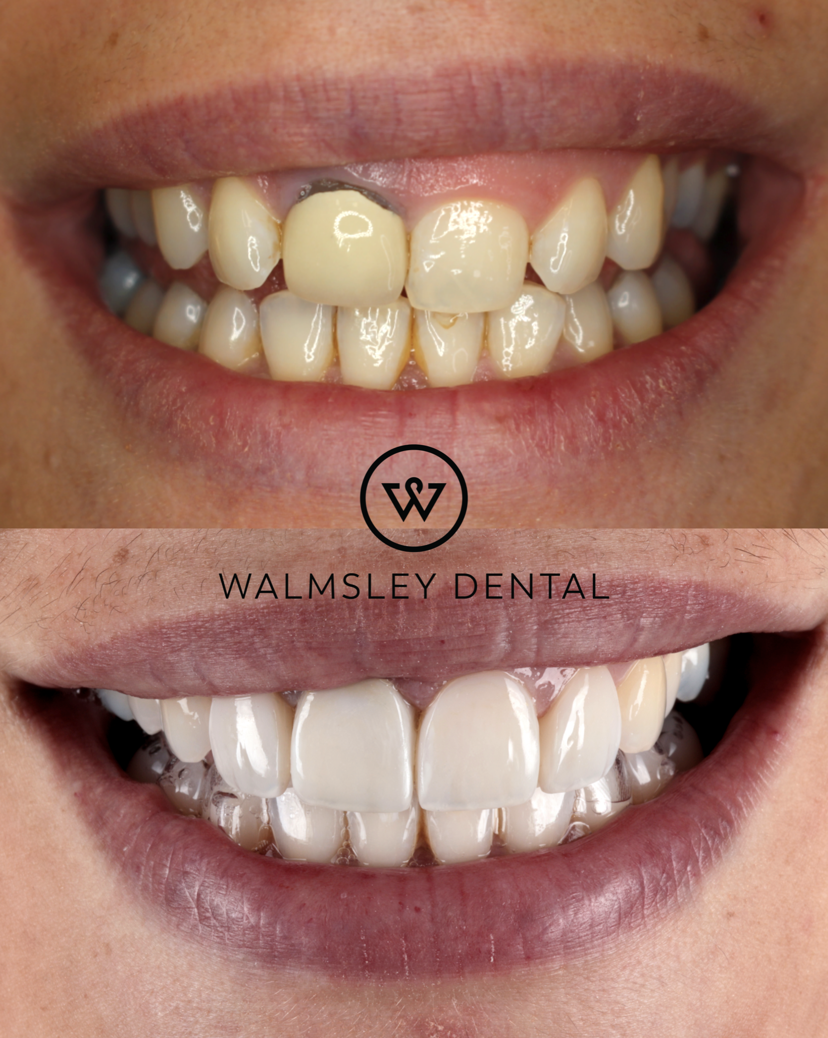 Invisalign and porcelain veneers before and after — Walmsley Dental Droylsden