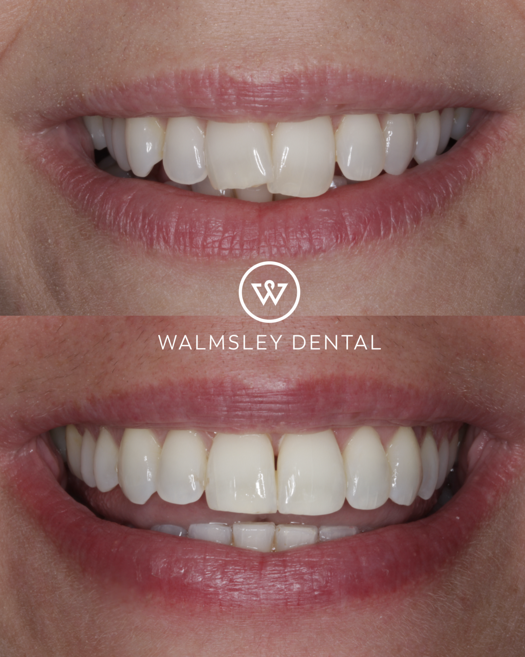 Walmsley Dental ceramic braces smile transformation
